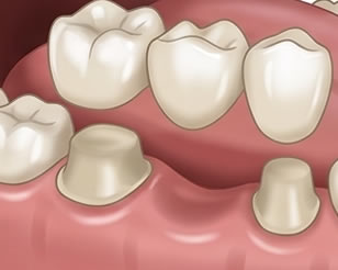 Link to more info about 1 Day Crowns