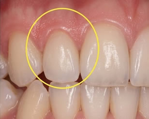 Link to more info about Gum Disease