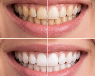 Link to more info about Teeth Whitening