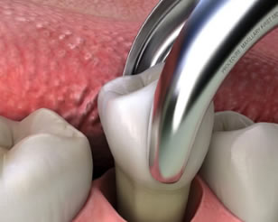 Link to more info about Extractions