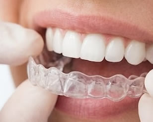 Link to more info about Invisalign