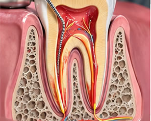 Link to more info about Root Canal