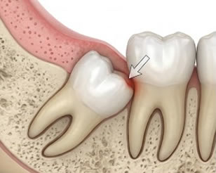 Link to more info about Wisdom Teeth